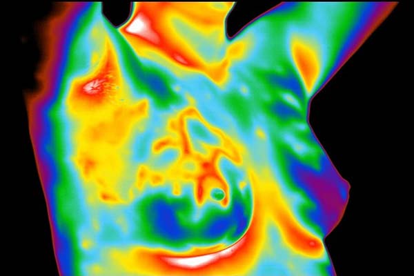 Breast Thermography: Technology, Benefits, and Cancer Signs